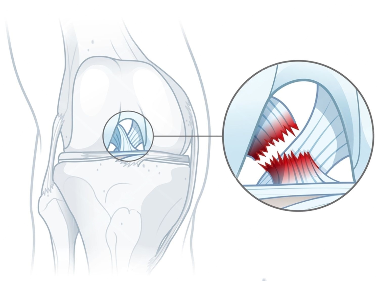 Ligamentoplastie LCA - Schéma anatomique